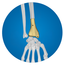 Icon: Distal radius replacement