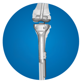 Icon: proximal tibia replacement