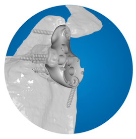Icon: Glenoid Replacement