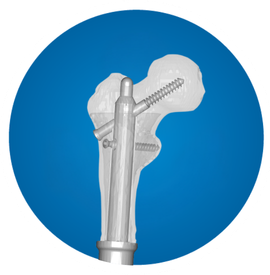 Icon: Prox. femoral Replacement