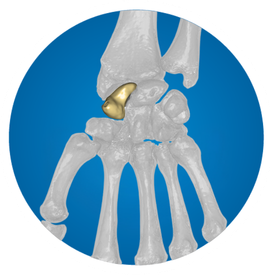 Icon: Scaphoid Replacement