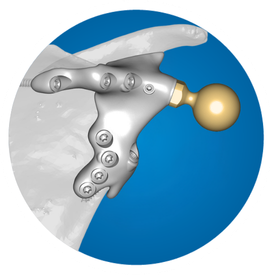 Icon: Scapula Replacement