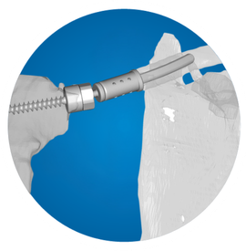 Icon: Sternoclavicular