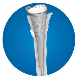 Icon: Tibial cone
