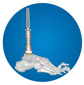 Icon: distal tibia replacement